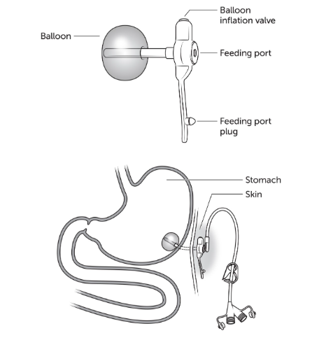 Low profile button gastrostomy Low profile button gastrostomy